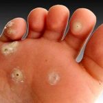 میخچه پا چیست و چگونه درمان می‌شود؟ + عکس میخچه پا